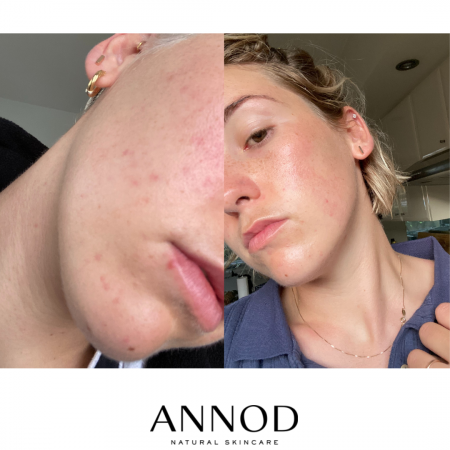 Glowing healed skin before and after results of using Balancing Lavender Face Oil