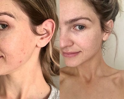 Before and After results of Annod's cutomer Courtney Allyce Love by usinng Annod Natural Skincare